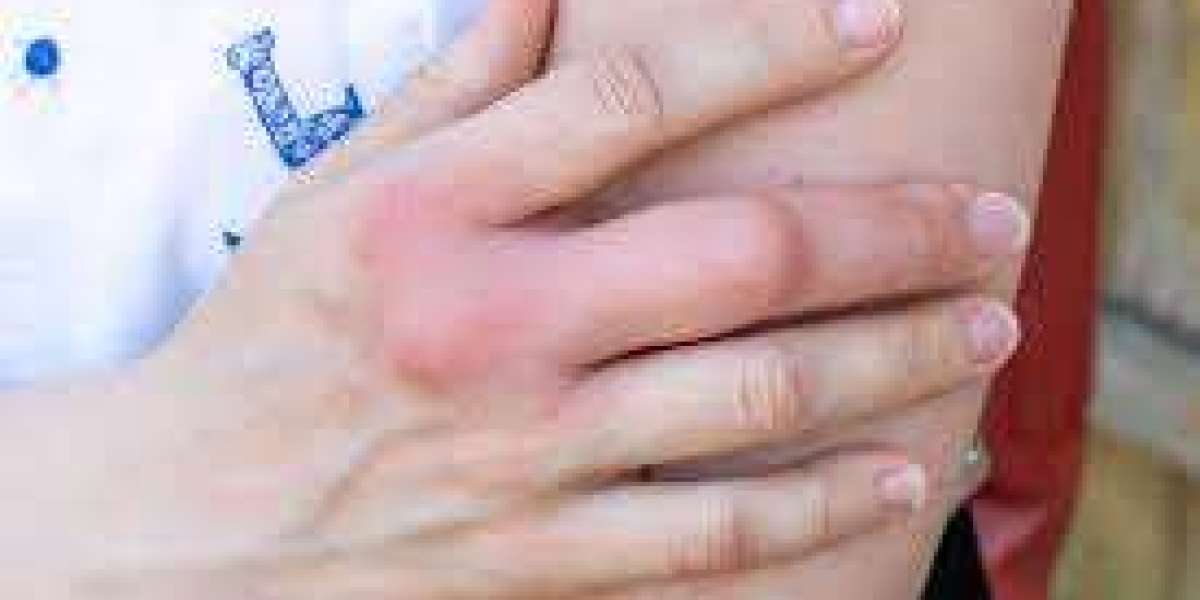 Wasp Sting | Immediate Remedies and Long-Term Care Tips