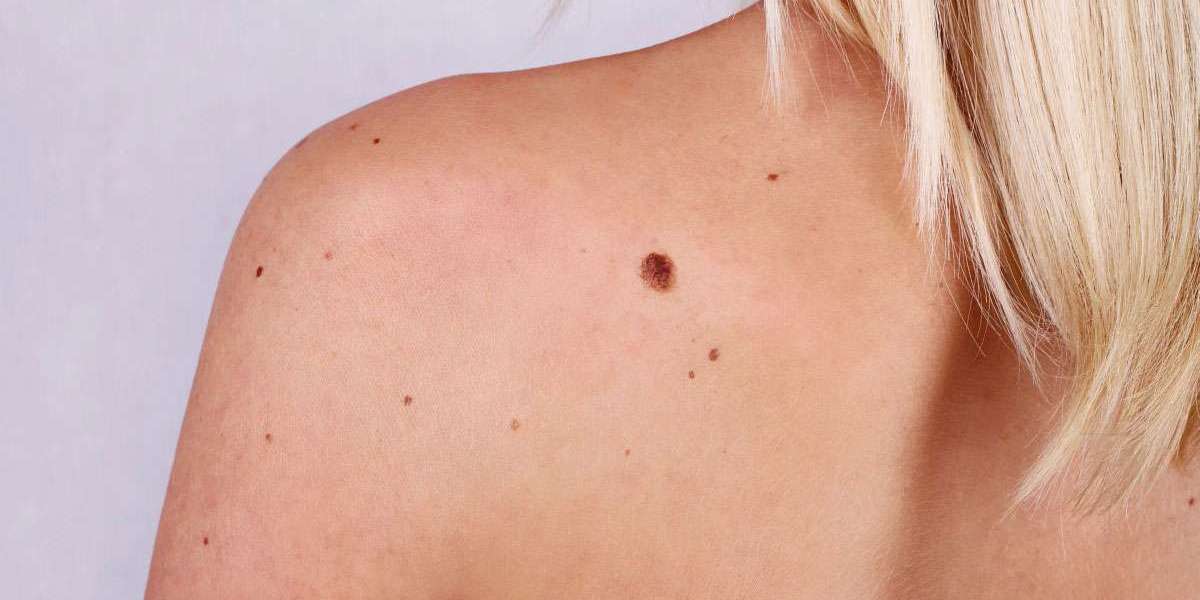 Are Skin Tags Contagious? What You Need to Know Before Touching