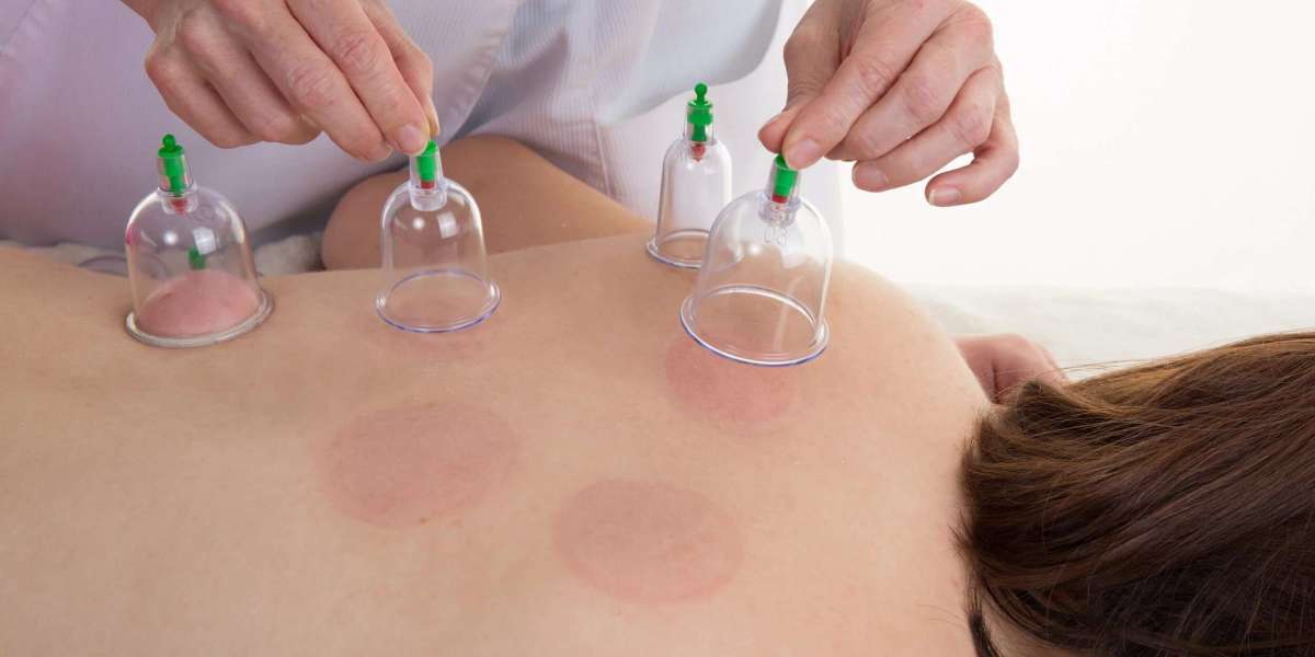 The Natural Wellness Boost You Get from Cupping Massage